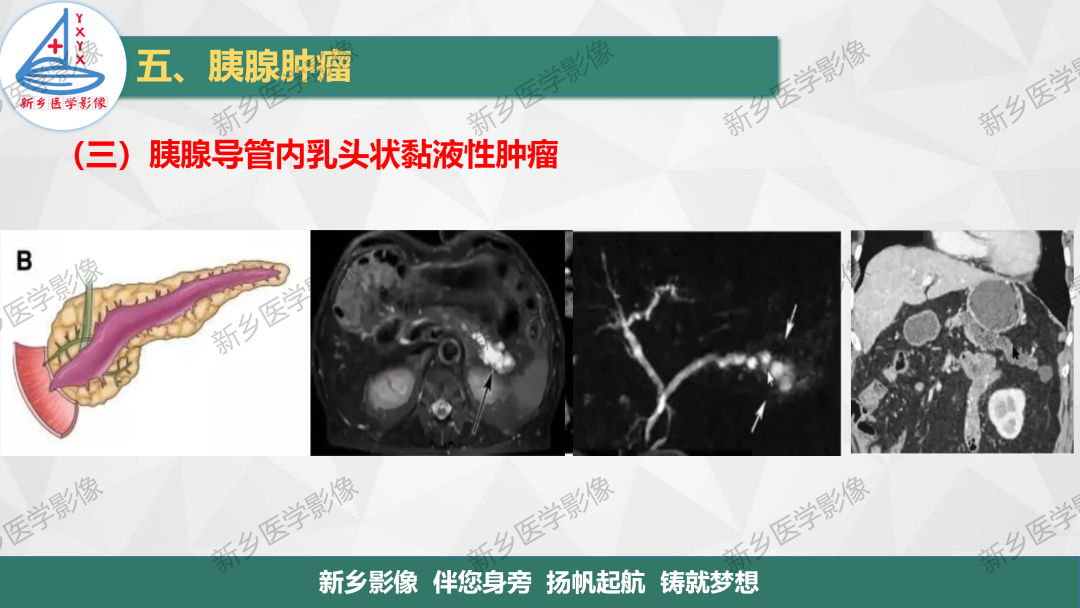 影像PPT - 【PPT】胰腺疾病影像表现-29