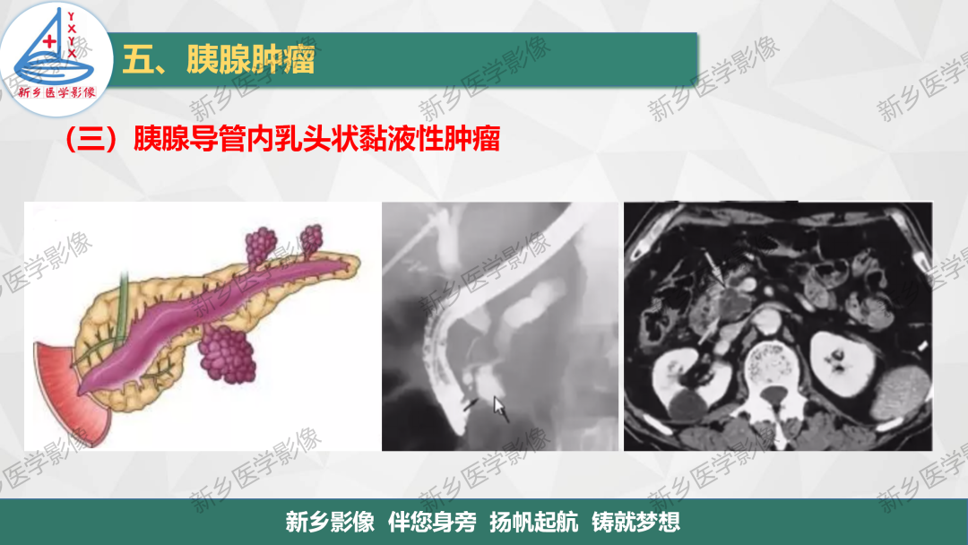 影像PPT - 【PPT】胰腺疾病影像表现-30