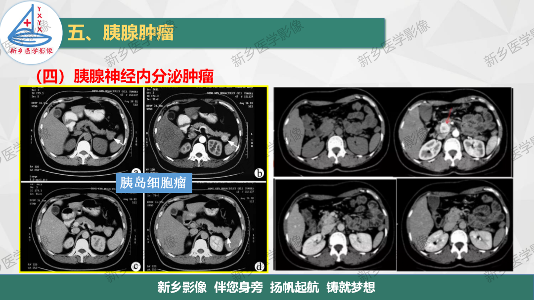 影像PPT - 【PPT】胰腺疾病影像表现-34