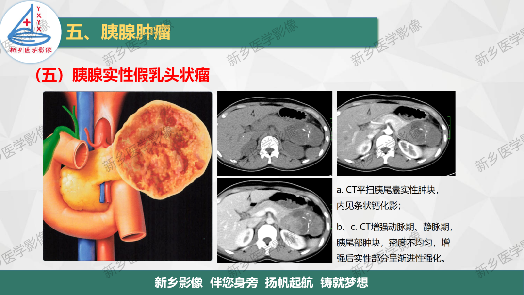 影像PPT - 【PPT】胰腺疾病影像表现-37