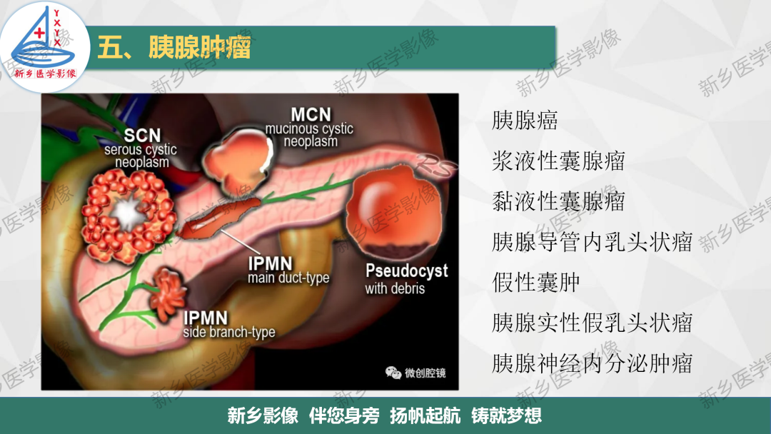 影像PPT - 【PPT】胰腺疾病影像表现-39