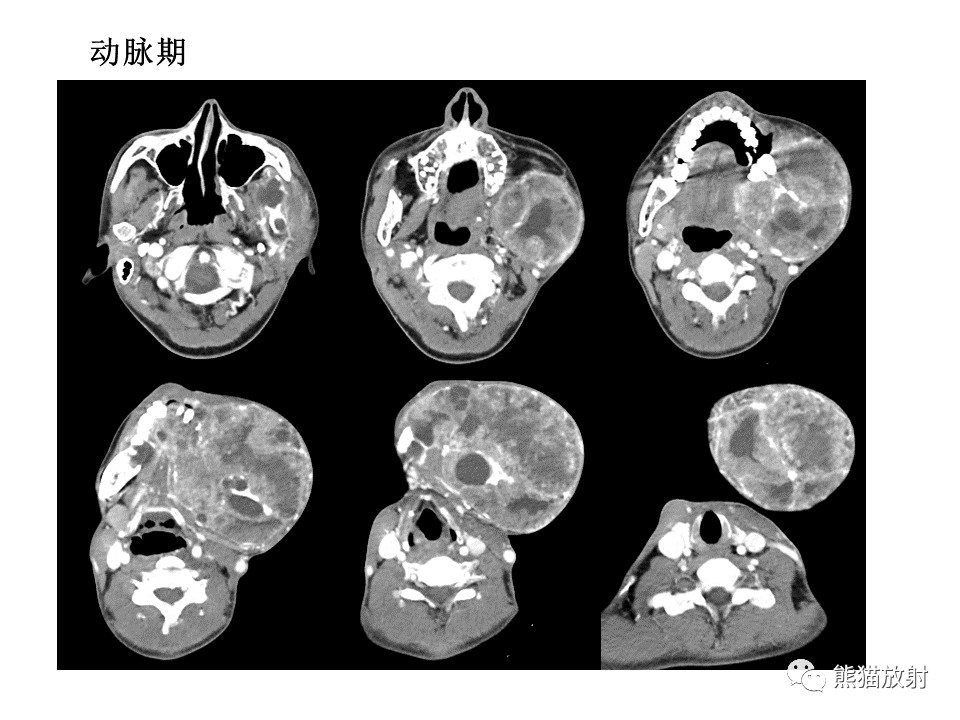 影像PPT - 【病例】颌骨成釉细胞瘤2例CT影像-5