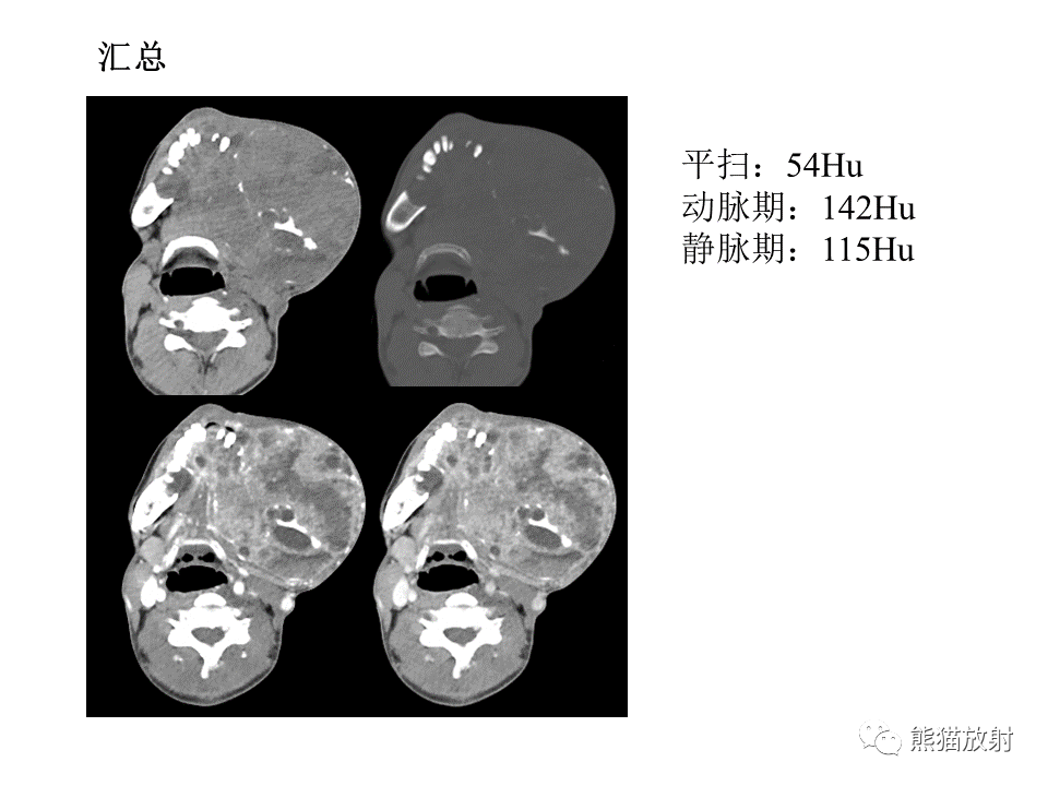 影像PPT - 【病例】颌骨成釉细胞瘤2例CT影像-7