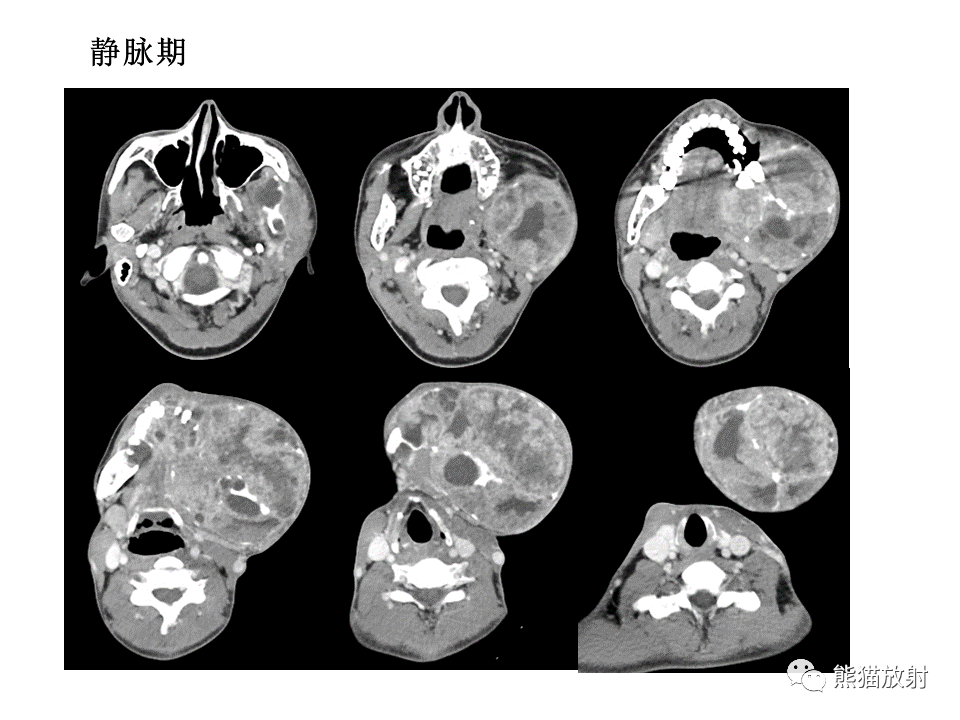 影像PPT - 【病例】颌骨成釉细胞瘤2例CT影像-6