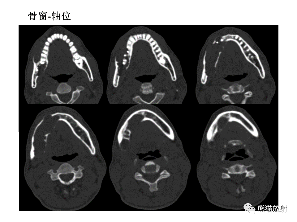 影像PPT - 【病例】颌骨成釉细胞瘤2例CT影像-11