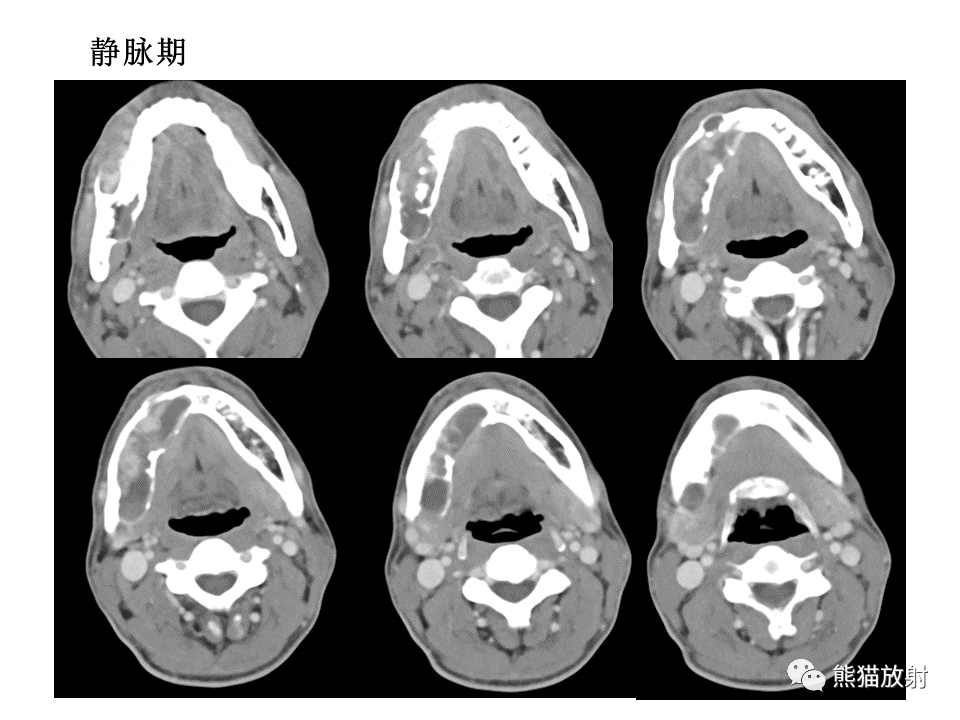 影像PPT - 【病例】颌骨成釉细胞瘤2例CT影像-14