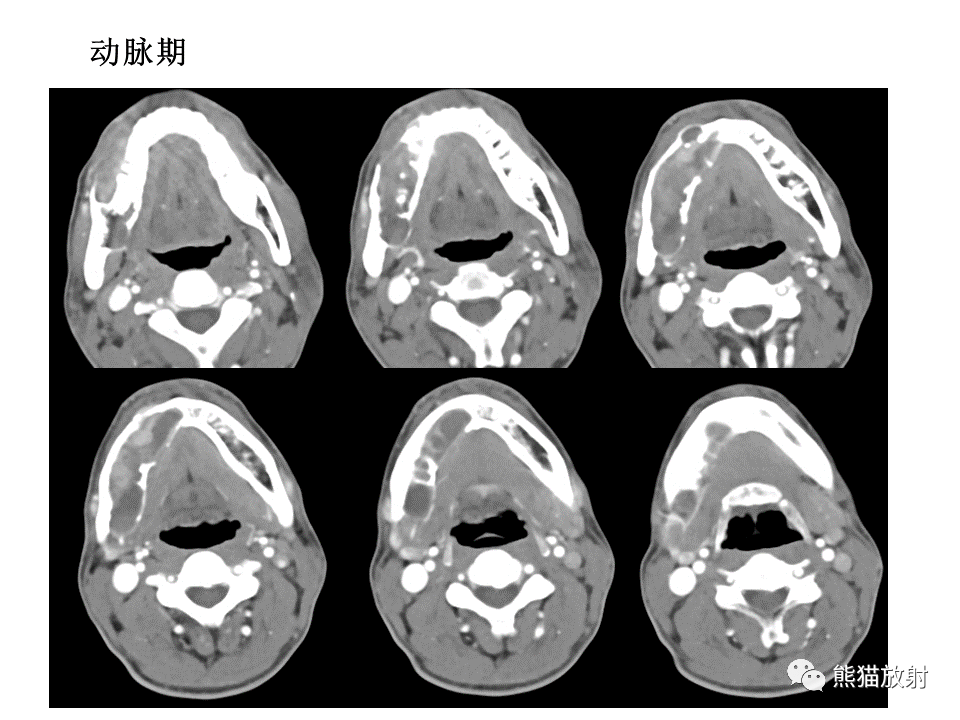 影像PPT - 【病例】颌骨成釉细胞瘤2例CT影像-13
