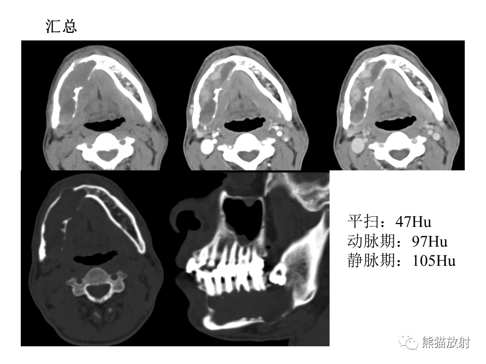 影像PPT - 【病例】颌骨成釉细胞瘤2例CT影像-15