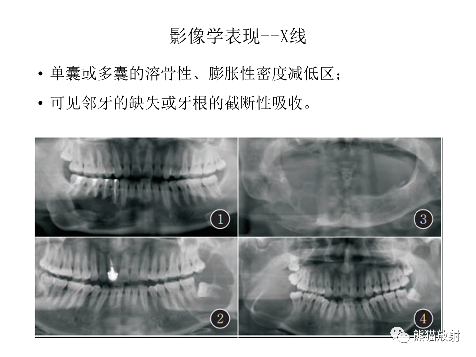 影像PPT - 【病例】颌骨成釉细胞瘤2例CT影像-20