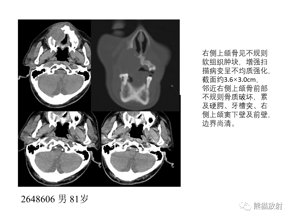 影像PPT - 【病例】颌骨成釉细胞瘤2例CT影像-23