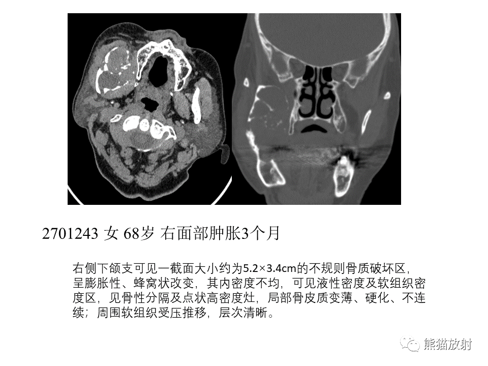 影像PPT - 【病例】颌骨成釉细胞瘤2例CT影像-24