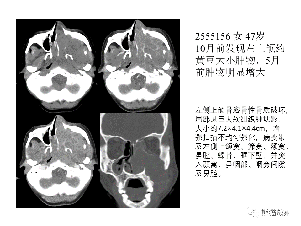 影像PPT - 【病例】颌骨成釉细胞瘤2例CT影像-25