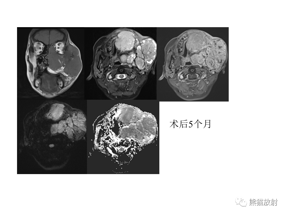 影像PPT - 【病例】颌骨成釉细胞瘤2例CT影像-26