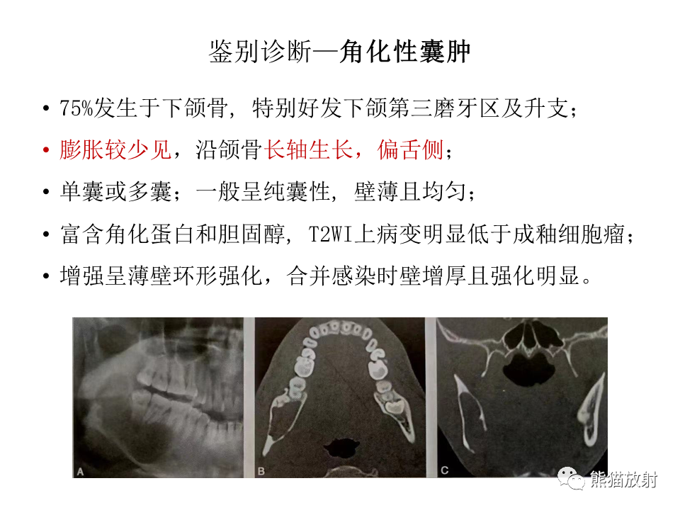 影像PPT - 【病例】颌骨成釉细胞瘤2例CT影像-28