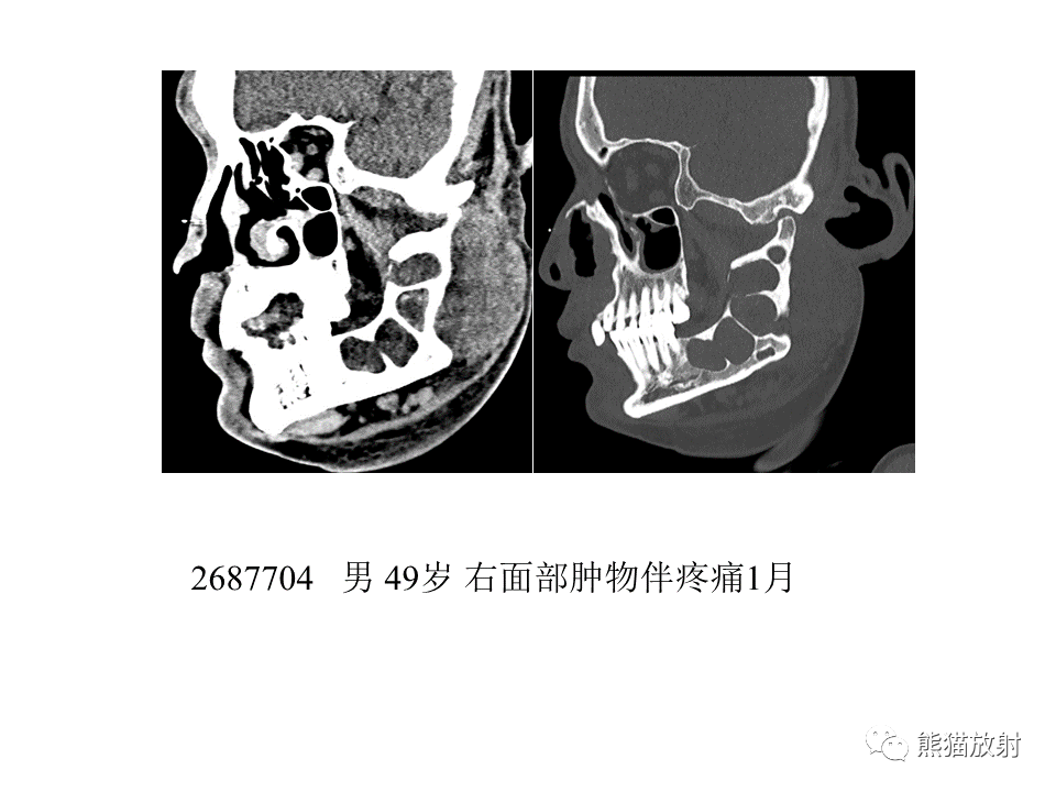 影像PPT - 【病例】颌骨成釉细胞瘤2例CT影像-29