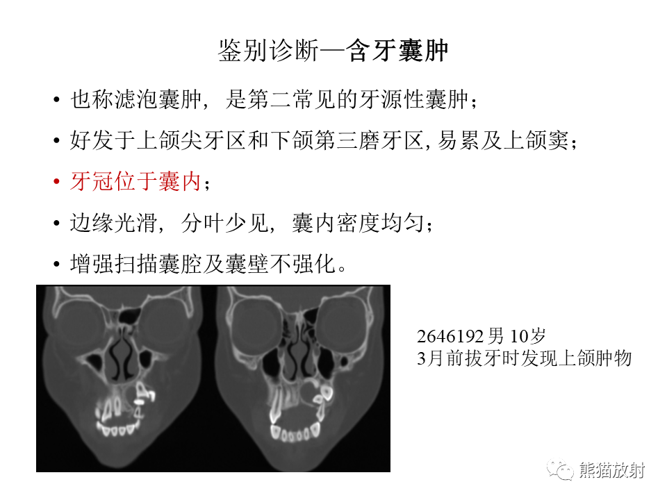 影像PPT - 【病例】颌骨成釉细胞瘤2例CT影像-30