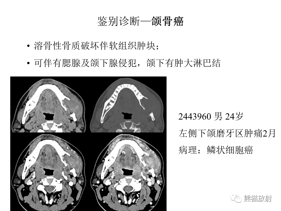 影像PPT - 【病例】颌骨成釉细胞瘤2例CT影像-34