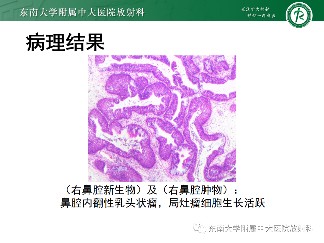 影像PPT - 【PPT】鼻内翻性乳头状瘤-3