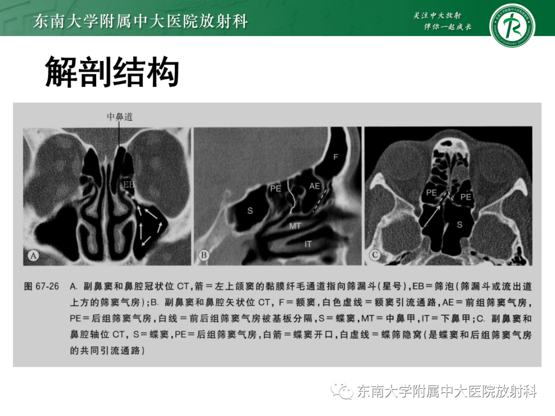 影像PPT - 【PPT】鼻内翻性乳头状瘤-5 影像PPT - 【PPT】鼻内翻性乳头状瘤-5