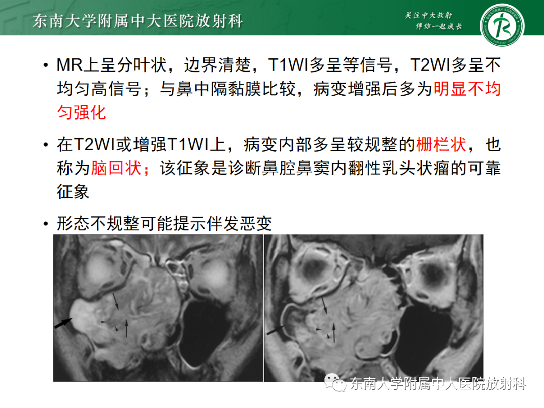 影像PPT - 【PPT】鼻内翻性乳头状瘤-11 影像PPT - 【PPT】鼻内翻性乳头状瘤-11