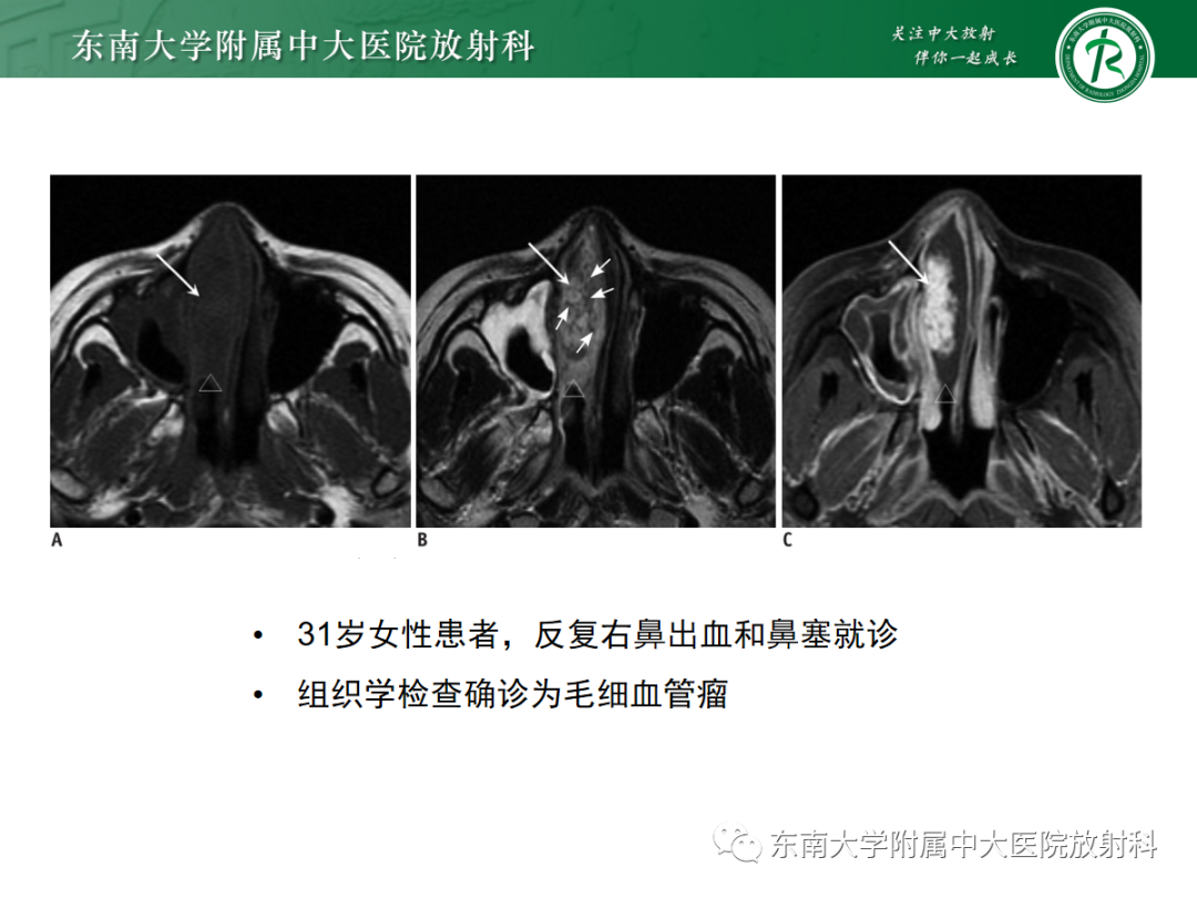 影像PPT - 【PPT】鼻内翻性乳头状瘤-18 影像PPT - 【PPT】鼻内翻性乳头状瘤-18