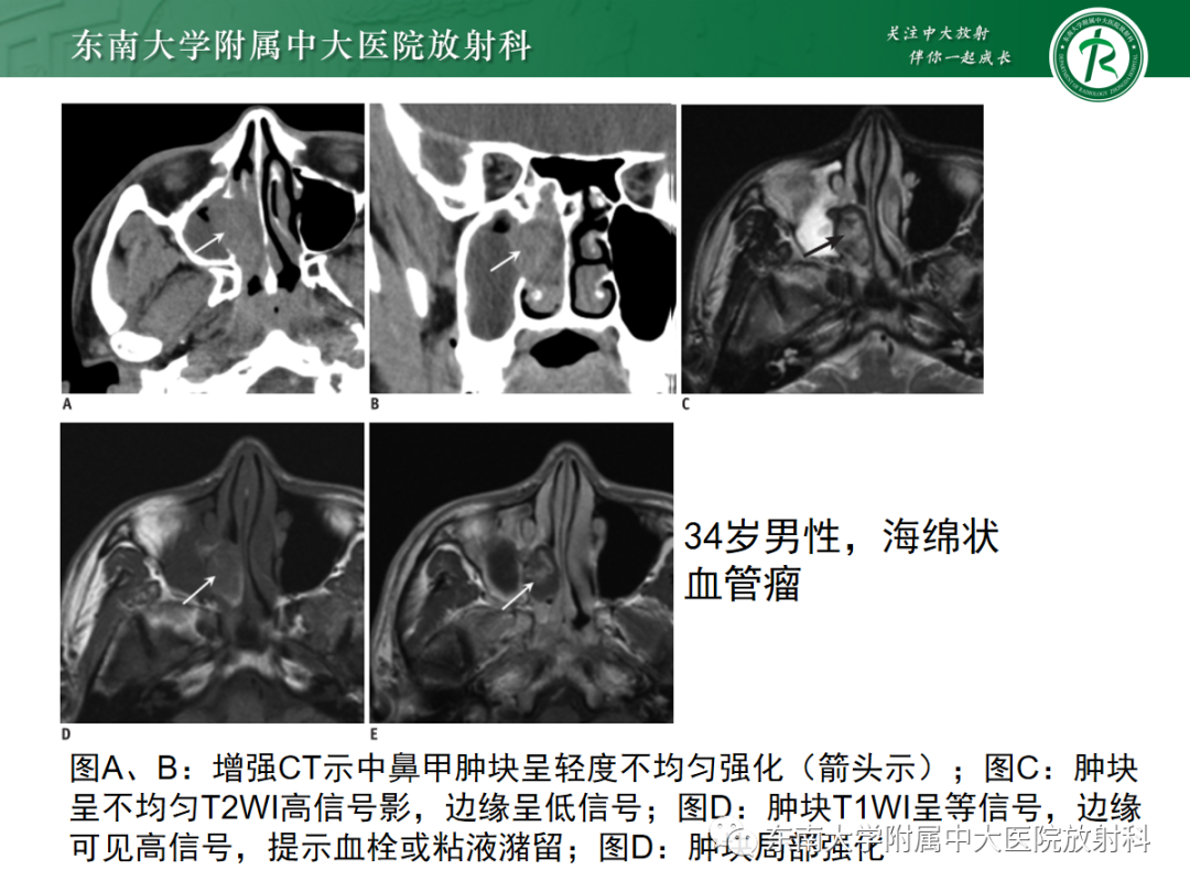 影像PPT - 【PPT】鼻内翻性乳头状瘤-17 影像PPT - 【PPT】鼻内翻性乳头状瘤-17