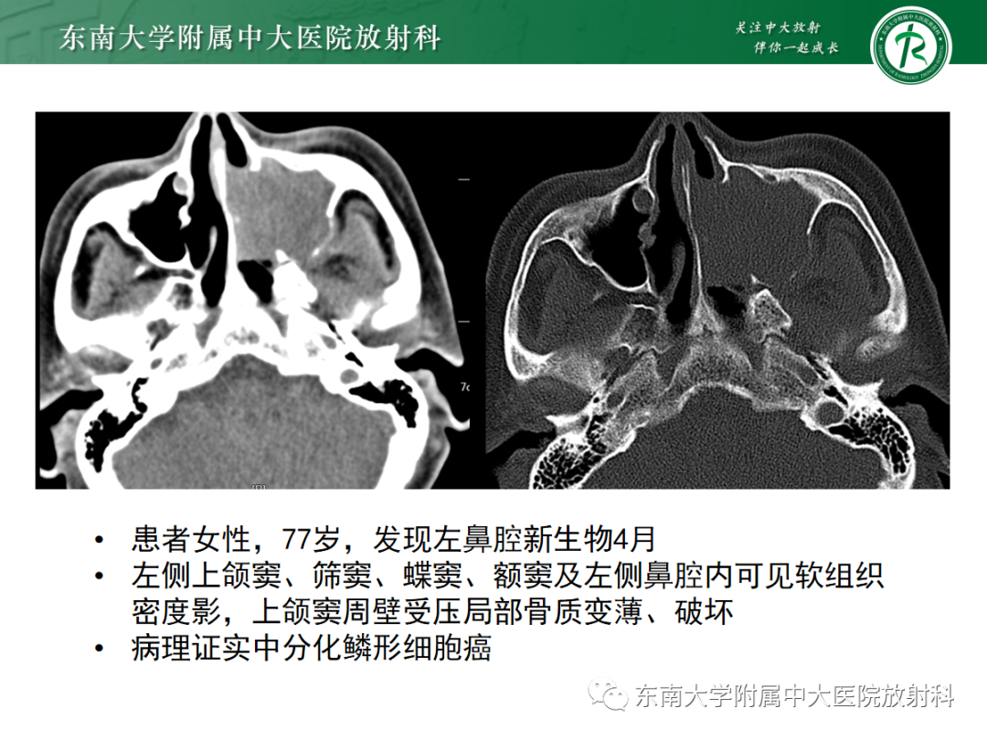 影像PPT - 【PPT】鼻内翻性乳头状瘤-21 影像PPT - 【PPT】鼻内翻性乳头状瘤-21