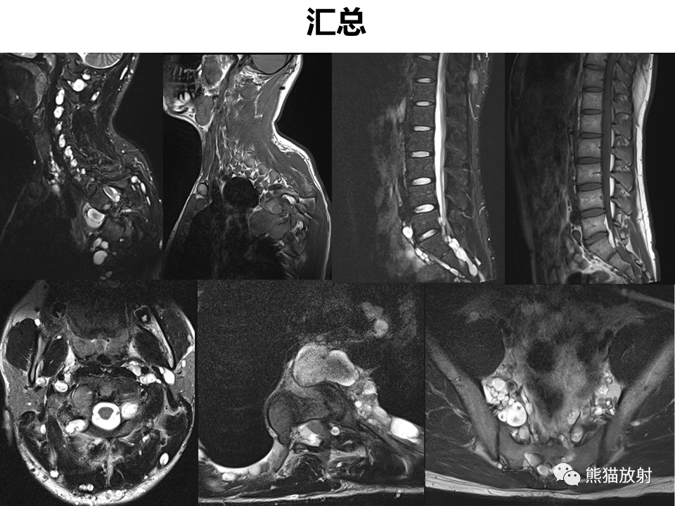 影像PPT - 【病例】神经纤维瘤病2例MR影像-9