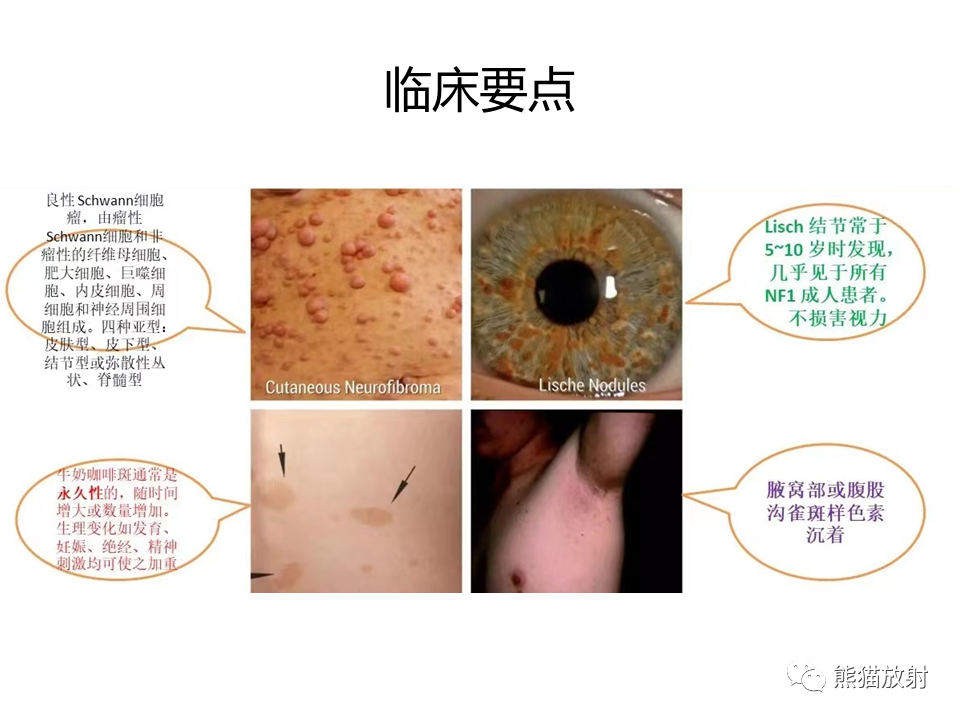 影像PPT - 【病例】神经纤维瘤病2例MR影像-26