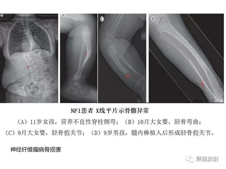 影像PPT - 【病例】神经纤维瘤病2例MR影像-28