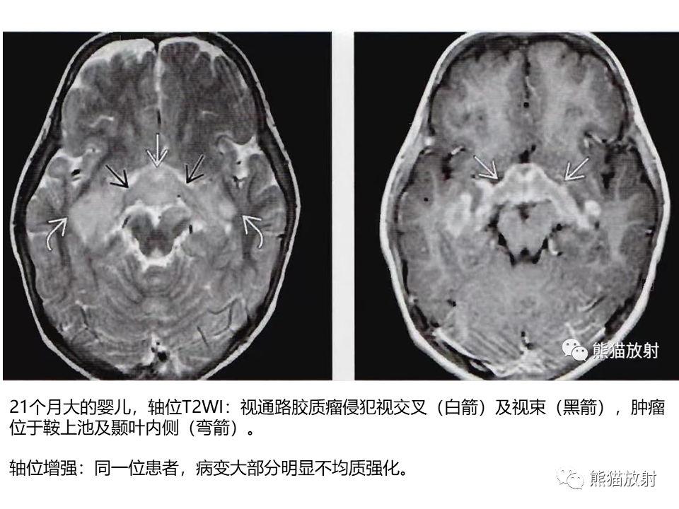 影像PPT - 【病例】神经纤维瘤病2例MR影像-30