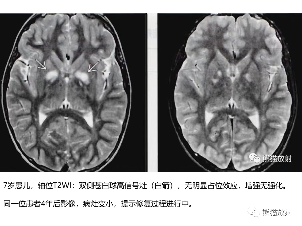 影像PPT - 【病例】神经纤维瘤病2例MR影像-31