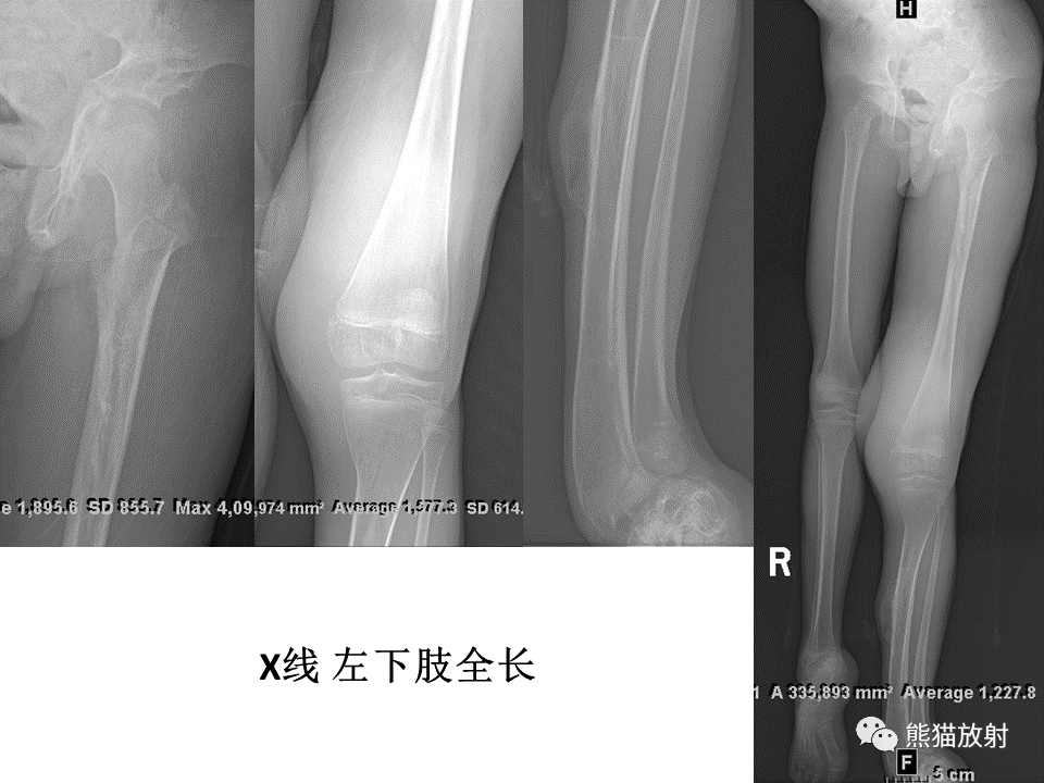 影像PPT - 【病例】神经纤维瘤病2例MR影像-7