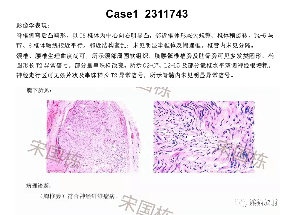影像PPT - 【病例】神经纤维瘤病2例MR影像-11