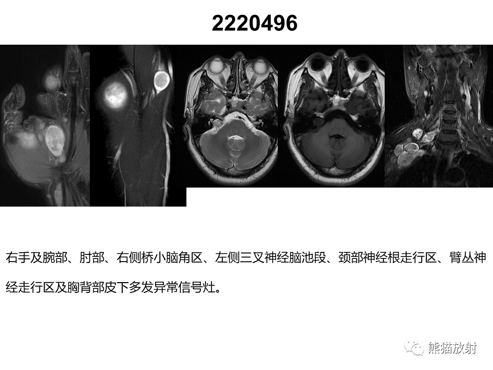 影像PPT - 【病例】神经纤维瘤病2例MR影像-18