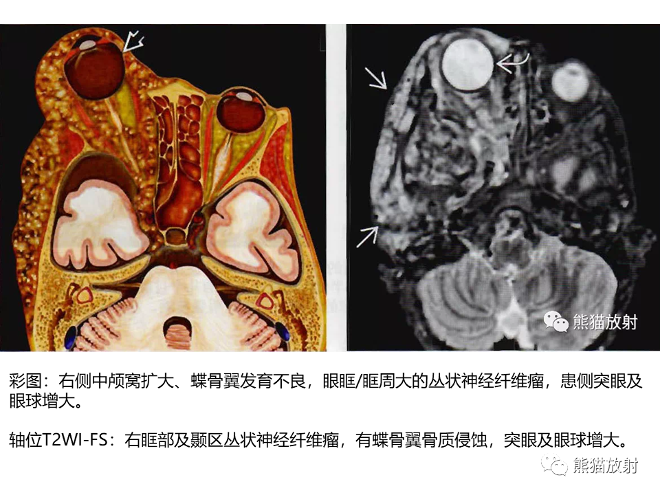 影像PPT - 【病例】神经纤维瘤病2例MR影像-16