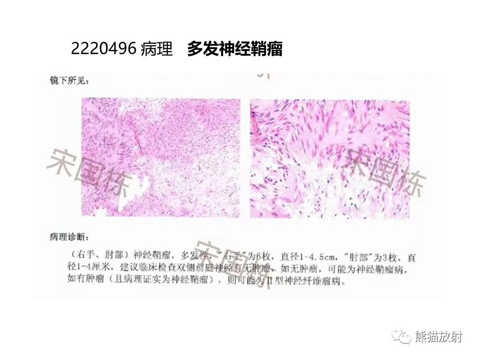 影像PPT - 【病例】神经纤维瘤病2例MR影像-19