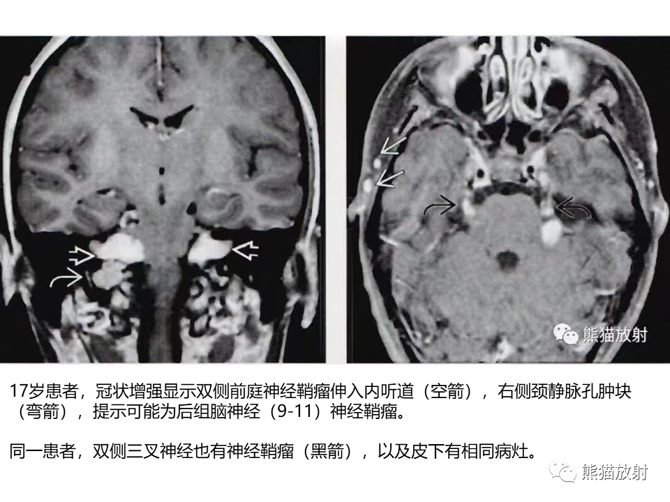 影像PPT - 【病例】神经纤维瘤病2例MR影像-21