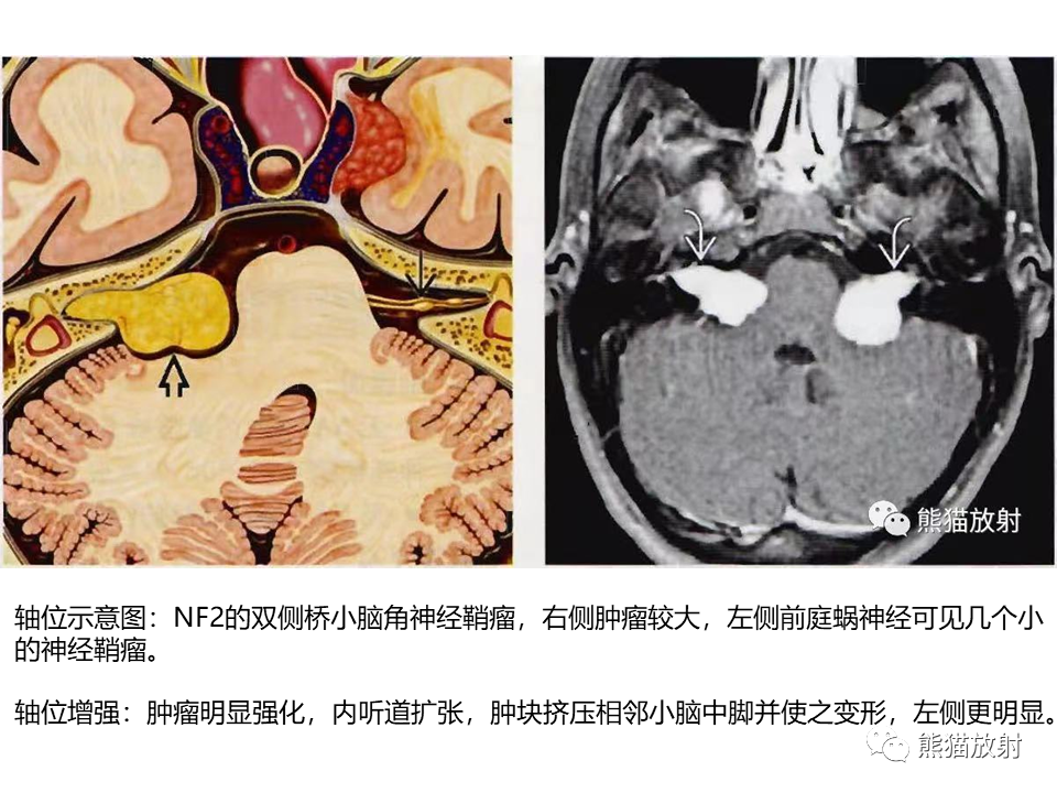 影像PPT - 【病例】神经纤维瘤病2例MR影像-20
