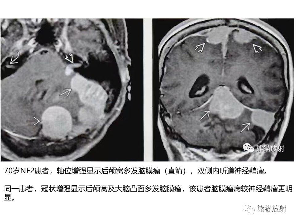 影像PPT - 【病例】神经纤维瘤病2例MR影像-22