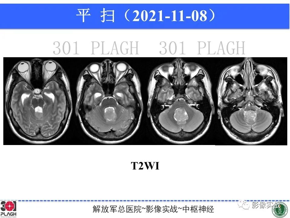 影像PPT - 【病例】四脑室非典型脉络丛乳头状瘤1例CT及MR-6