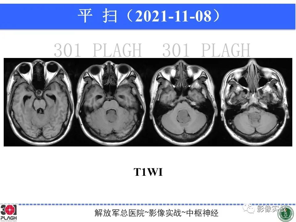 影像PPT - 【病例】四脑室非典型脉络丛乳头状瘤1例CT及MR-7