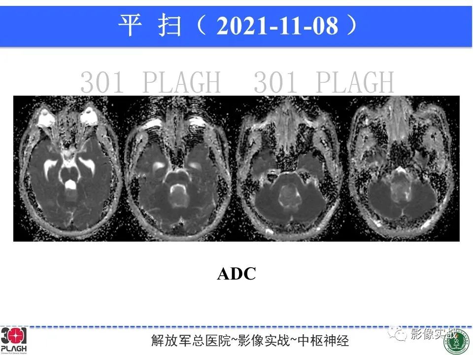 影像PPT - 【病例】四脑室非典型脉络丛乳头状瘤1例CT及MR-9