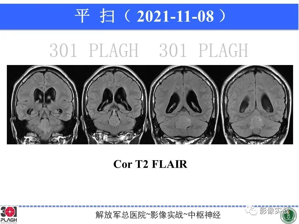 影像PPT - 【病例】四脑室非典型脉络丛乳头状瘤1例CT及MR-10
