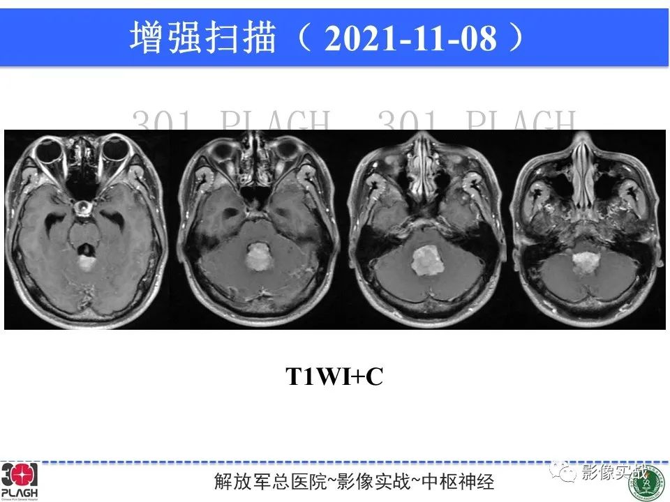 影像PPT - 【病例】四脑室非典型脉络丛乳头状瘤1例CT及MR-12