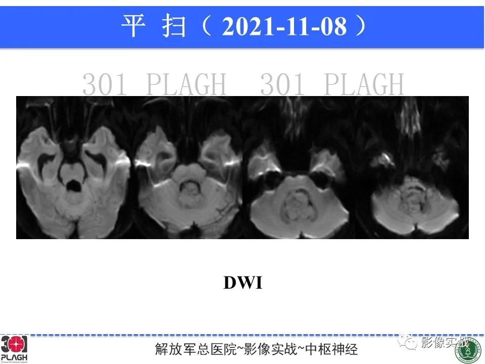 影像PPT - 【病例】四脑室非典型脉络丛乳头状瘤1例CT及MR-8