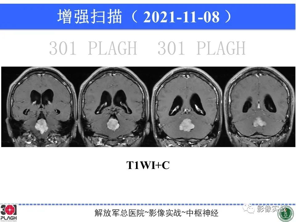 影像PPT - 【病例】四脑室非典型脉络丛乳头状瘤1例CT及MR-13