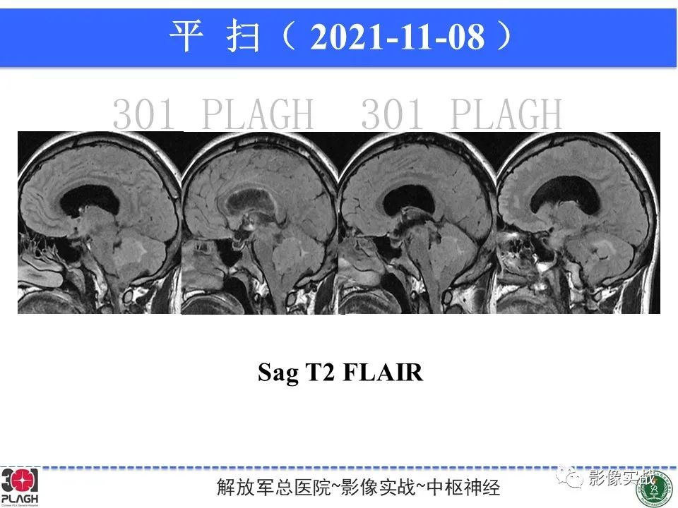 影像PPT - 【病例】四脑室非典型脉络丛乳头状瘤1例CT及MR-11