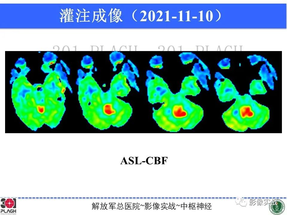 影像PPT - 【病例】四脑室非典型脉络丛乳头状瘤1例CT及MR-16