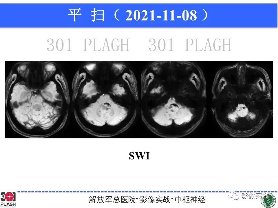 影像PPT - 【病例】四脑室非典型脉络丛乳头状瘤1例CT及MR-15